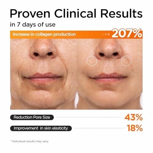 Before and after images showing skin improvement with increased collagen production.