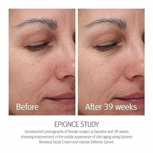 Comparison of a woman's face before and after 39 weeks of using Epionce products.