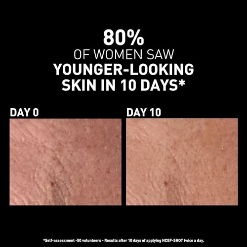 Comparison of skin before and after 10 days of treatment showing younger-looking skin.