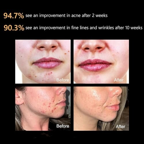 Before and after images showing skin improvement in acne and wrinkles.