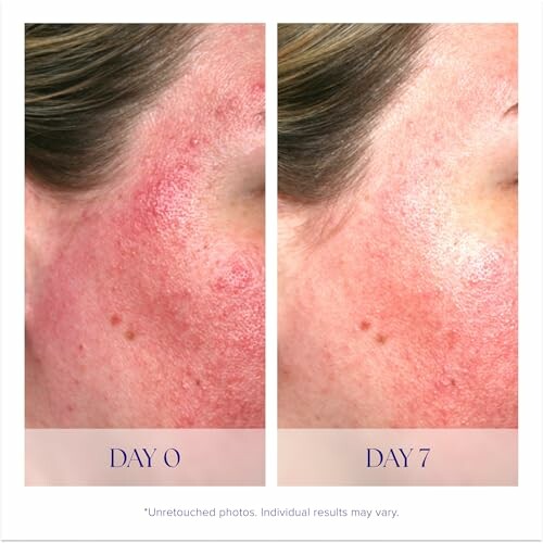 Comparison of skin condition on Day 0 and Day 7 showing improvement.