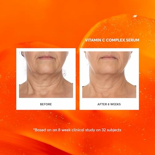 Comparison of neck skin before and after 8 weeks using Vitamin C Complex Serum.