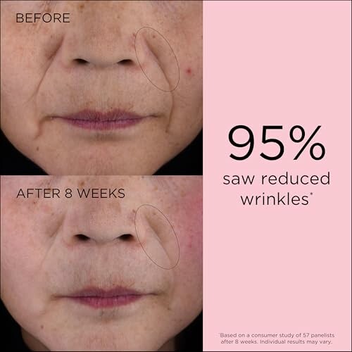 Before and after 8 weeks wrinkle reduction results on face.