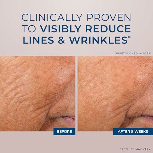 Comparison image showing reduction in lines and wrinkles before and after 8 weeks.